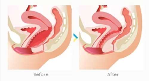 私密缩紧 私密缩紧